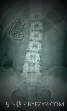 X射线扫描器胃截图6