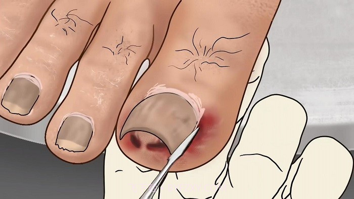 修脚足疔模拟器高画质版截图1 修脚足疔模拟器高画质版截图1